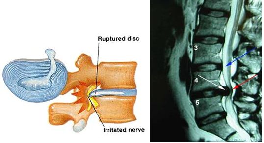 ernia discale